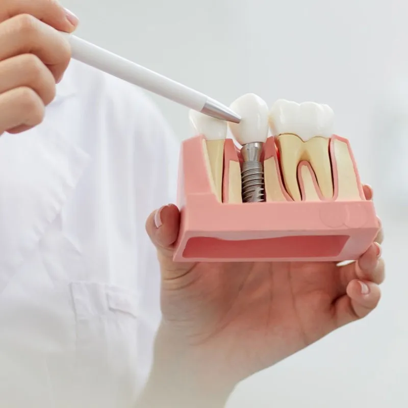 En İyi Diş İmplantı Markası Nasıl Seçilir? 