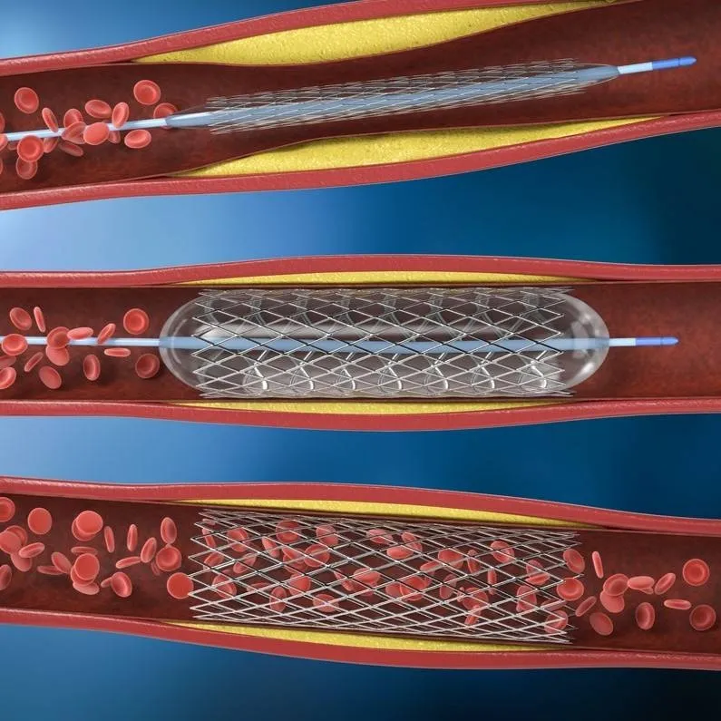 Kalp Krizi Riskini Azaltan Stent Uygulaması